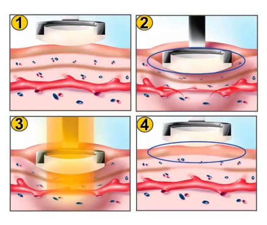 Candela Vbeam Perfecta